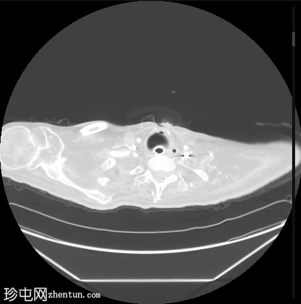 气管切开管套囊过度充气