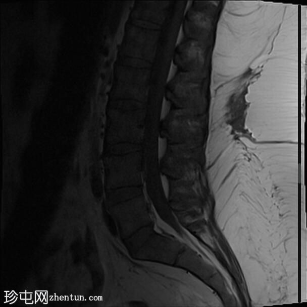 脊髓硬膜外静脉丛扩张