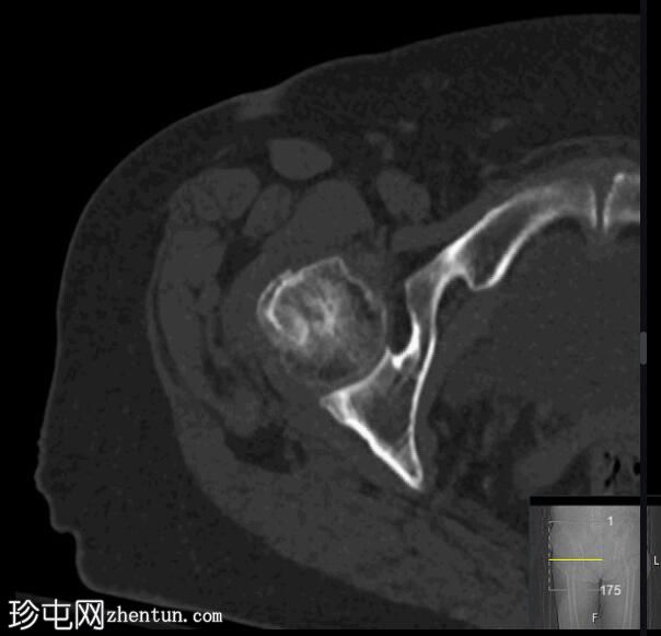 Garden I型股骨颈骨折