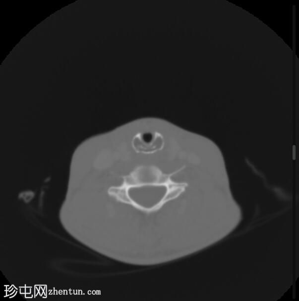 复发性多软骨炎