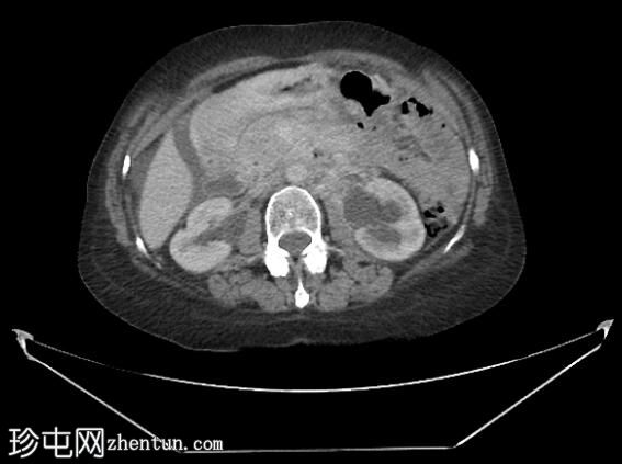 乳腺癌的跨体腔扩散