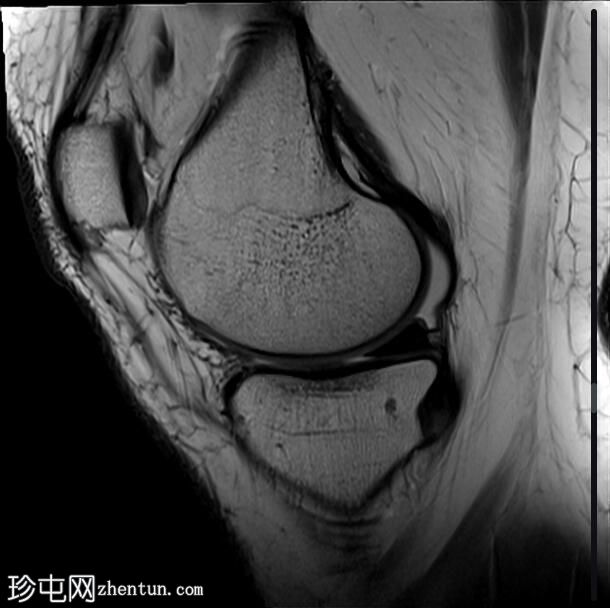 髌腱-股骨外侧髁摩擦综合征