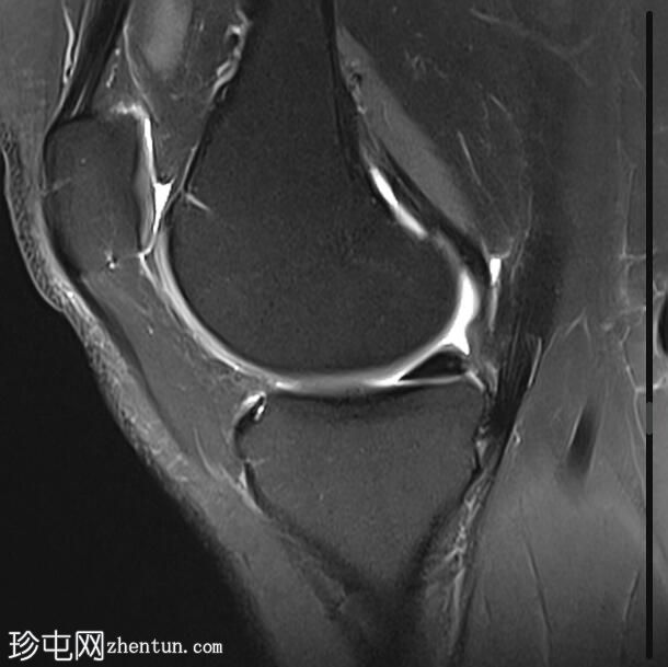 髌腱-股骨外侧髁摩擦综合征