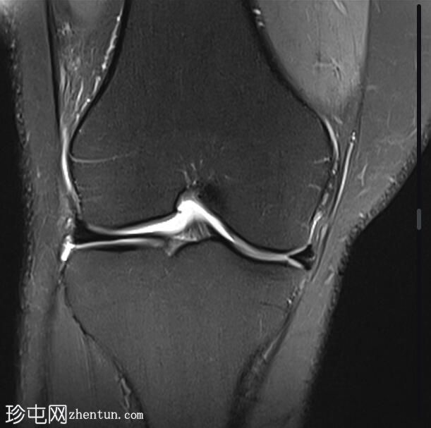 髌腱-股骨外侧髁摩擦综合征