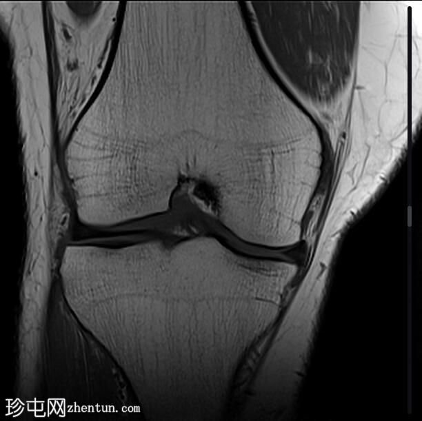 髌腱-股骨外侧髁摩擦综合征