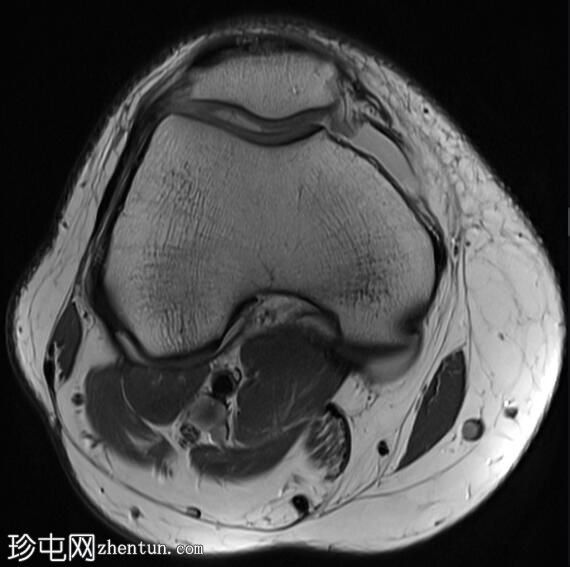 髌腱-股骨外侧髁摩擦综合征