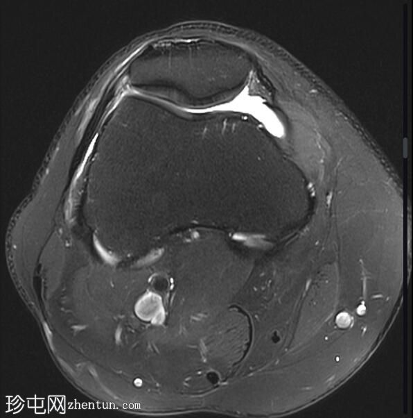 髌腱-股骨外侧髁摩擦综合征