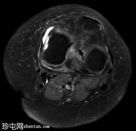 膝关节半月板损伤伴半月板旁囊肿