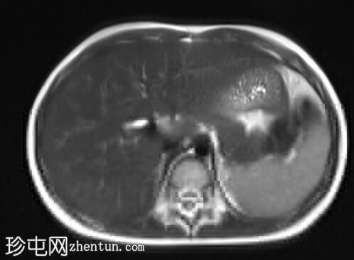 胆总管囊肿 - 1 型