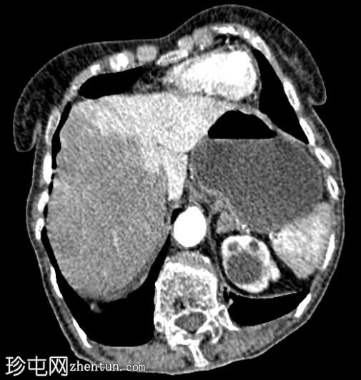 肠系膜上动脉及肝右动脉替代血栓