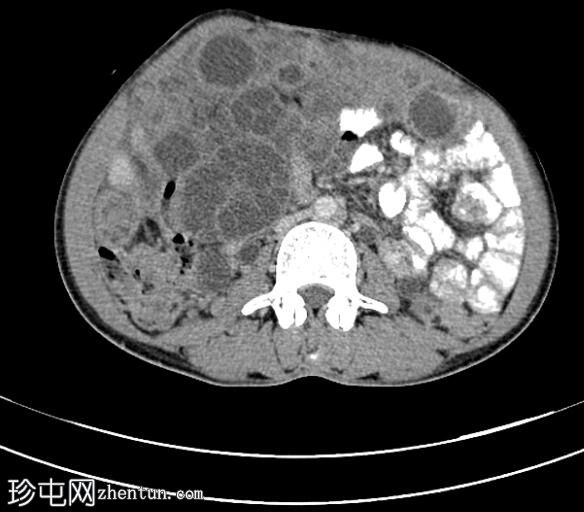 播散性腹膜包虫病