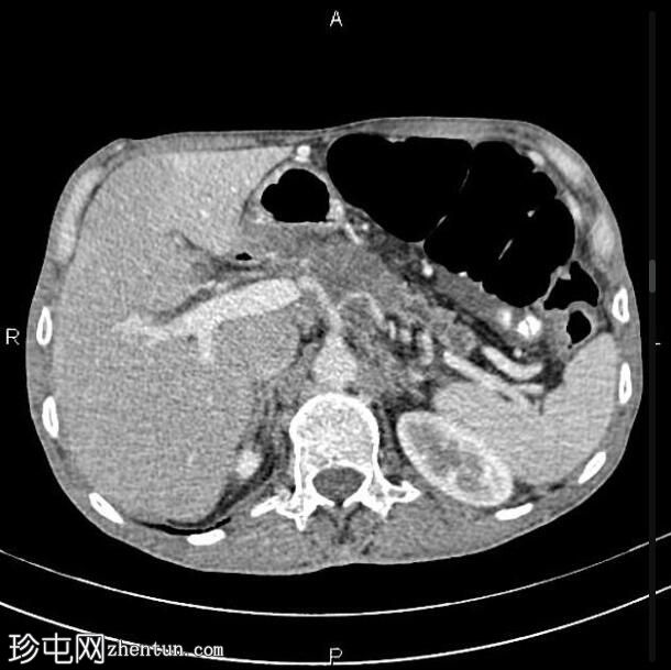 局部晚期转移性胰腺导管腺癌