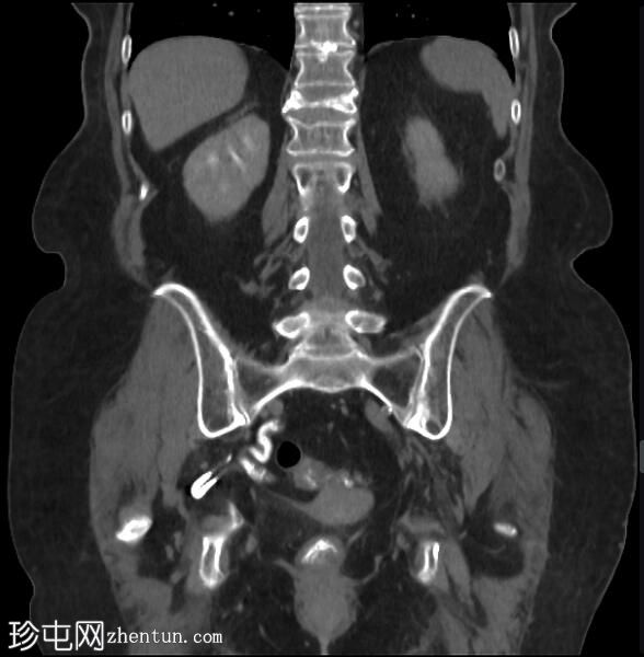 输尿管坐骨疝