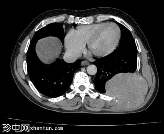 胸壁转移——肝细胞癌