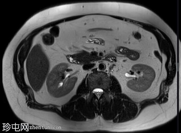 正常 MRI 肾脏