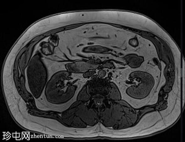 正常 MRI 肾脏