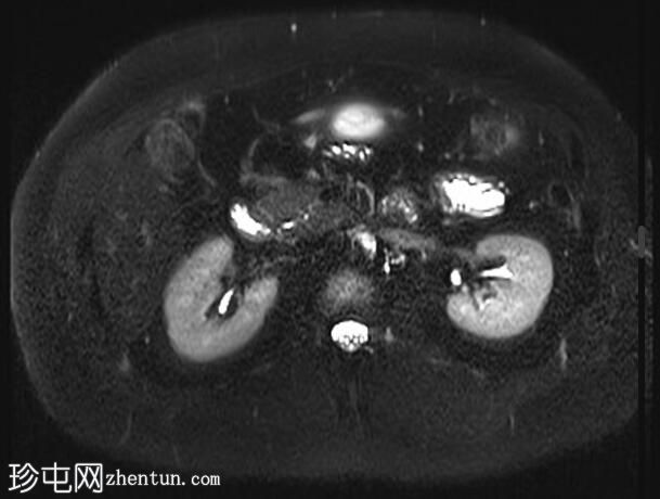 正常 MRI 肾脏