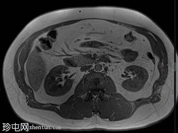 正常 MRI 肾脏