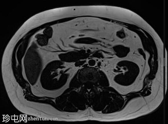 正常 MRI 肾脏