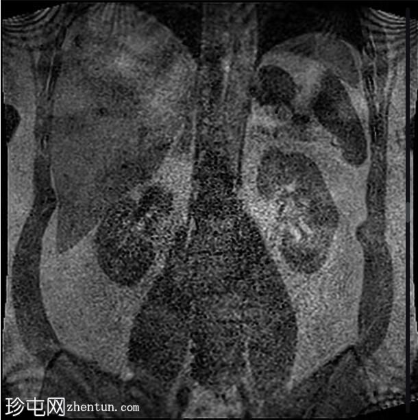 正常 MRI 肾脏