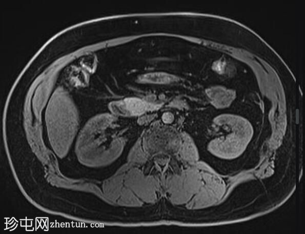 正常 MRI 肾脏