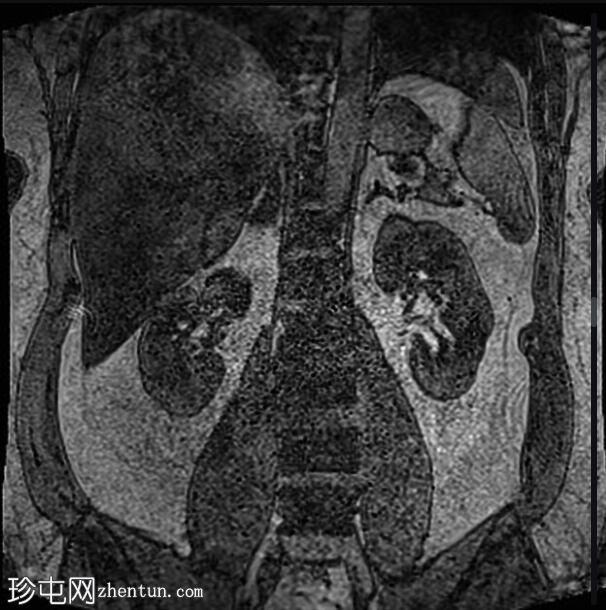 正常 MRI 肾脏