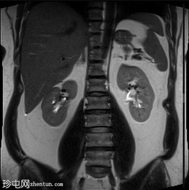 正常 MRI 肾脏