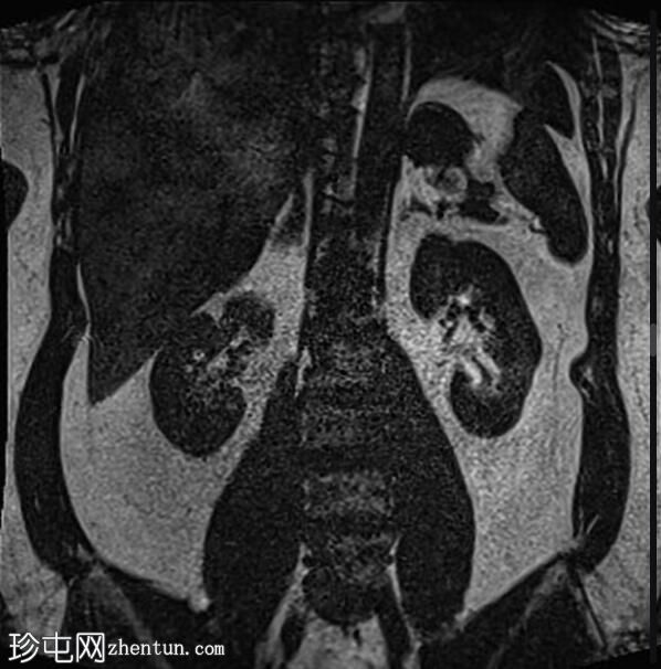 正常 MRI 肾脏