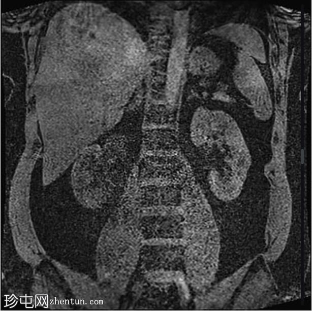 正常 MRI 肾脏