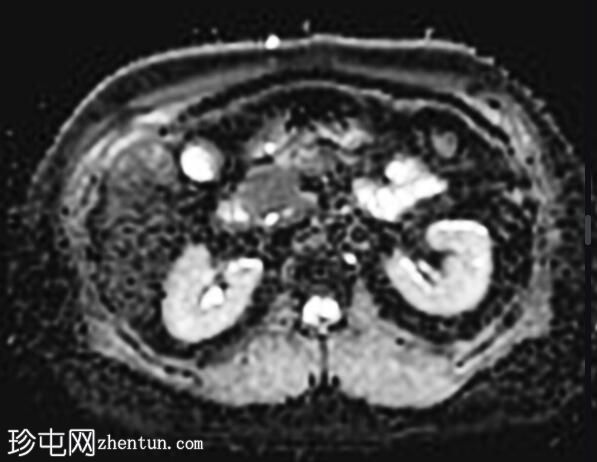 正常 MRI 肾脏