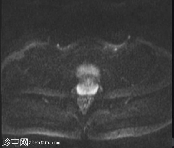 阴部神经MRI（男性）