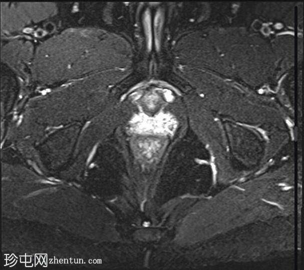 阴部神经MRI（男性）