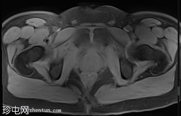 阴部神经MRI（男性）