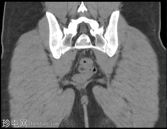 阴部神经MRI（男性）