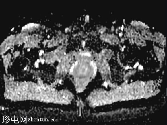 阴部神经MRI（男性）