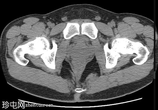 阴部神经MRI（男性）