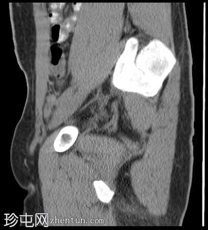 阴部神经MRI（男性）