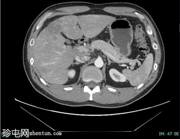 上皮样血管内皮瘤 (FDG PET-CT)