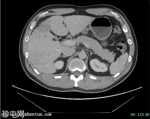 上皮样血管内皮瘤 (FDG PET-CT)