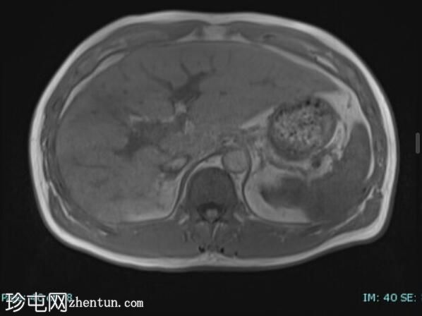 上皮样血管内皮瘤 (FDG PET-CT)