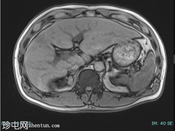 上皮样血管内皮瘤 (FDG PET-CT)