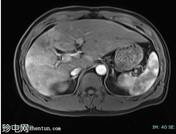 上皮样血管内皮瘤 (FDG PET-CT)