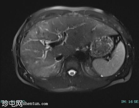 上皮样血管内皮瘤 (FDG PET-CT)