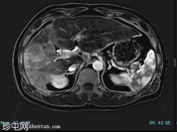 上皮样血管内皮瘤 (FDG PET-CT)