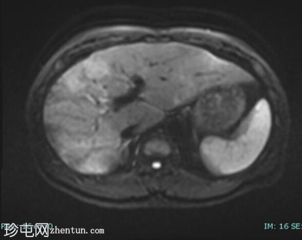 上皮样血管内皮瘤 (FDG PET-CT)