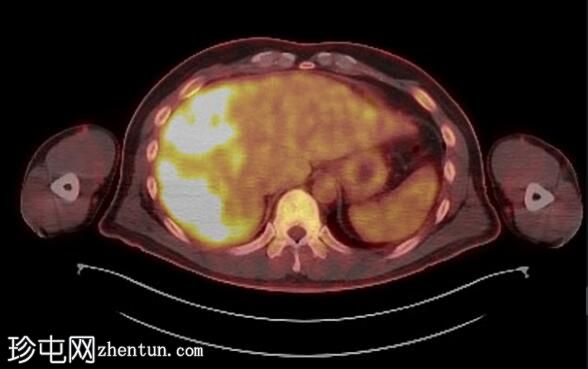 上皮样血管内皮瘤 (FDG PET-CT)