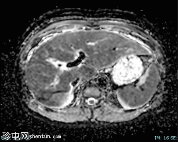 上皮样血管内皮瘤 (FDG PET-CT)