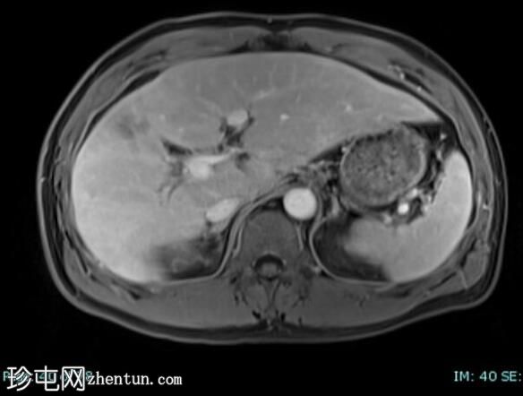 上皮样血管内皮瘤 (FDG PET-CT)