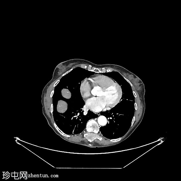 脊椎浆细胞瘤、巨大肝血管瘤