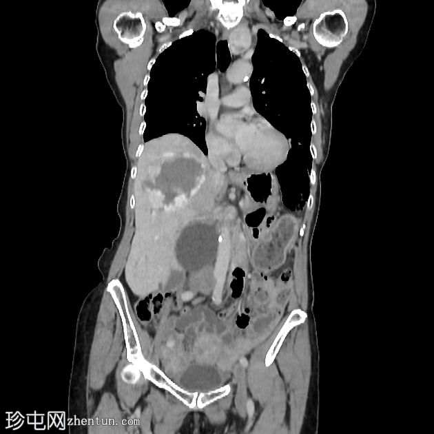 脊椎浆细胞瘤、巨大肝血管瘤